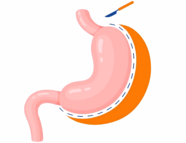 Sleeve Gastrique Tunisie